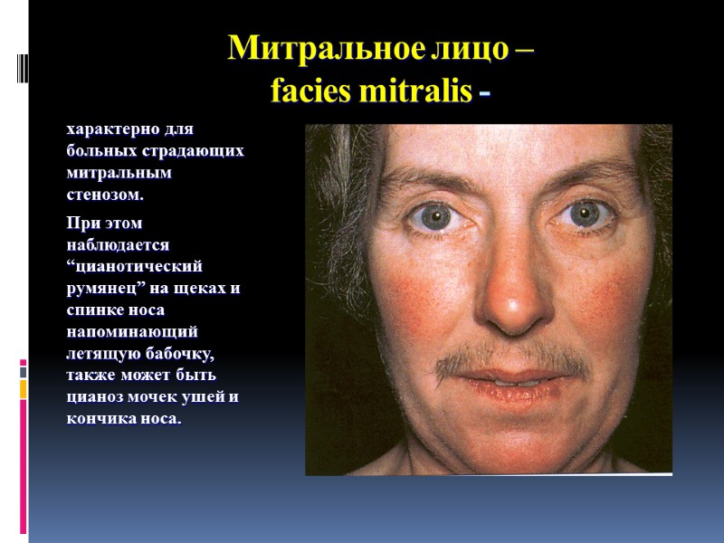 Митральное лицо – facies mitralis - характерно для больных страдающих митральным стенозом.  При